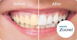 Refresher kits 9.5%  Phillips ZOOM! - Teeth Whitening Benefit 